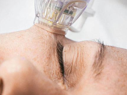 Collection image for: VIVACE MICRONEEDLING RF