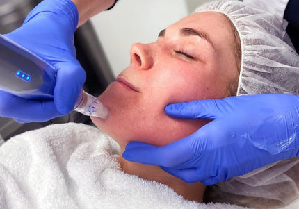SkinPen Microneedling