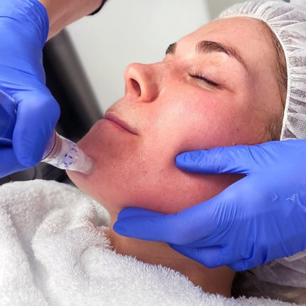 SkinPen Microneedling