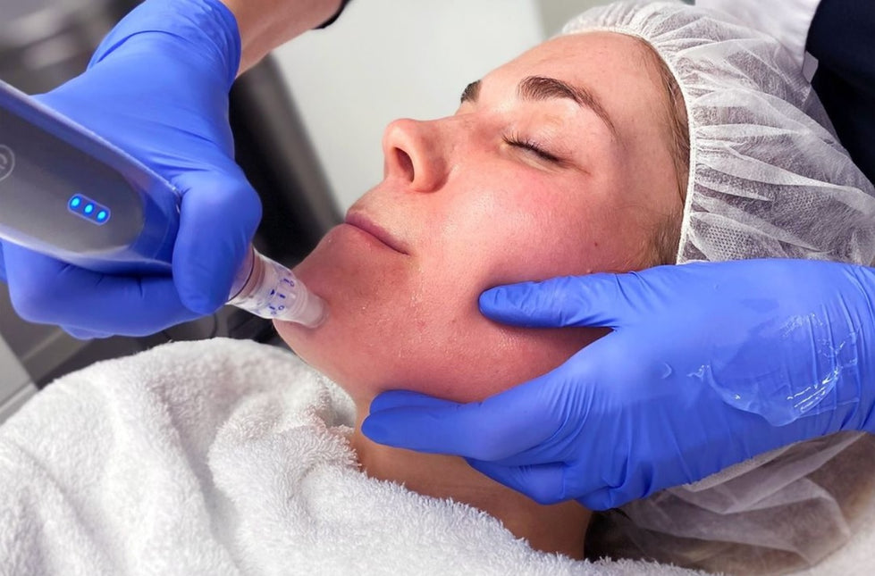 SkinPen Microneedling
