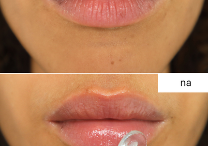 HA Densimatrix LIPS (voor lippen) Mesoestetic
