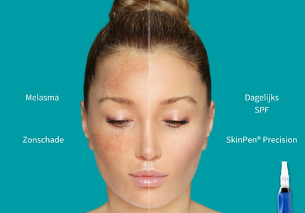 SkinPen Microneedling