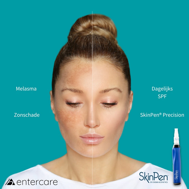 SkinPen Microneedling